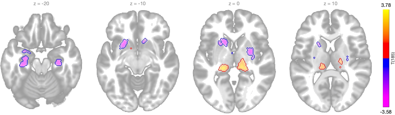 Four axial brain slices at z = -20, -10, 0, and 10 millimeters, showing subcortical clusters of group functional-connectivity differences with a T-statistic color scale from -3.58 to 3.78